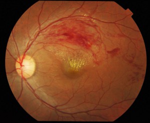 Color Fundus photograph of left eye showing retinal vein (https://commons.wikimedia.org/wiki/Retina#/)